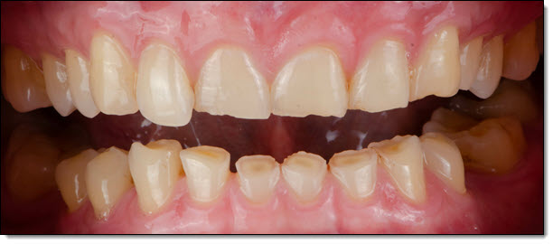 Bruxism