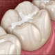 Dental Sealants