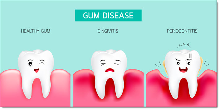 Gingivitis