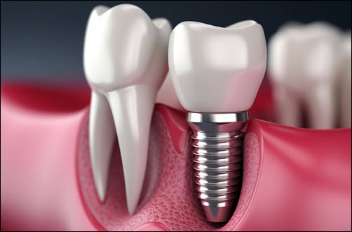 Dental Implants